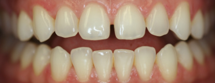 top gap tooth and crooked bottom before ortho