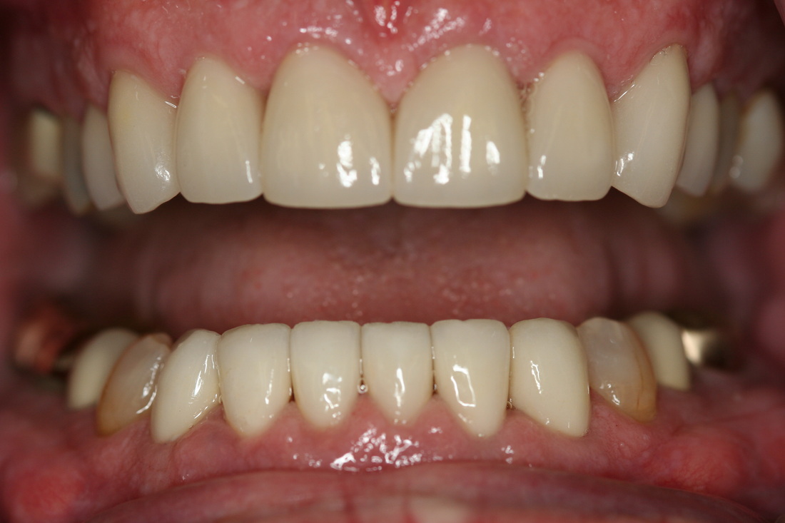 After dental crowns — restored smile