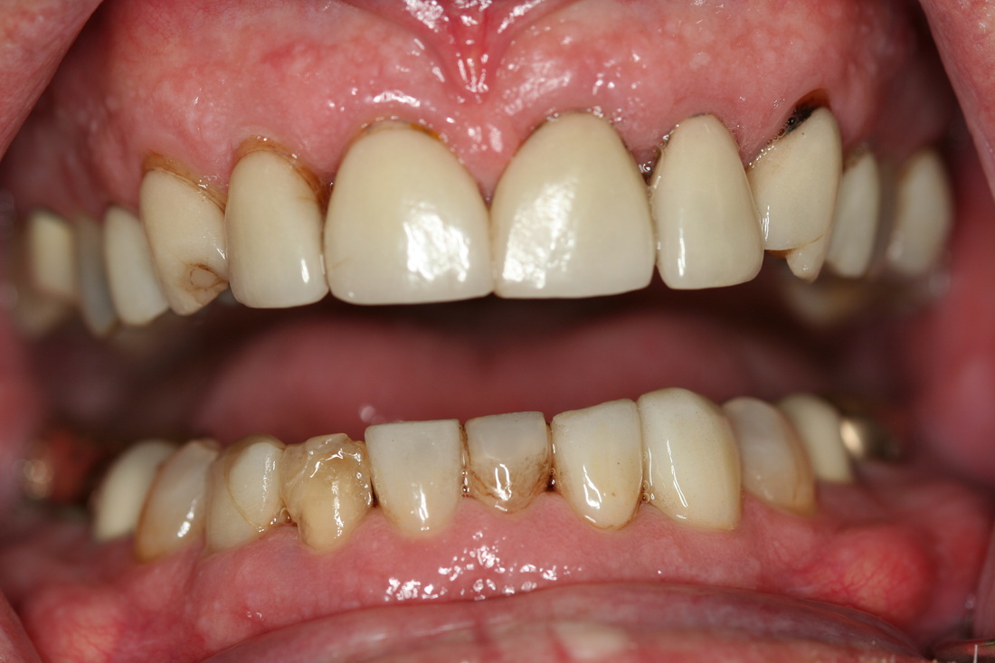 Before dental crowns