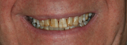 Before — Veneer case — corrected chips and discoloration