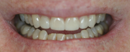 after veneers