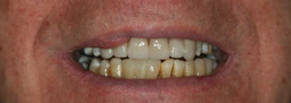 after veneers