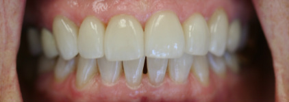 top gap tooth and crooked bottom after ortho