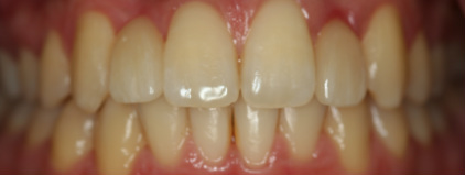 before veneers