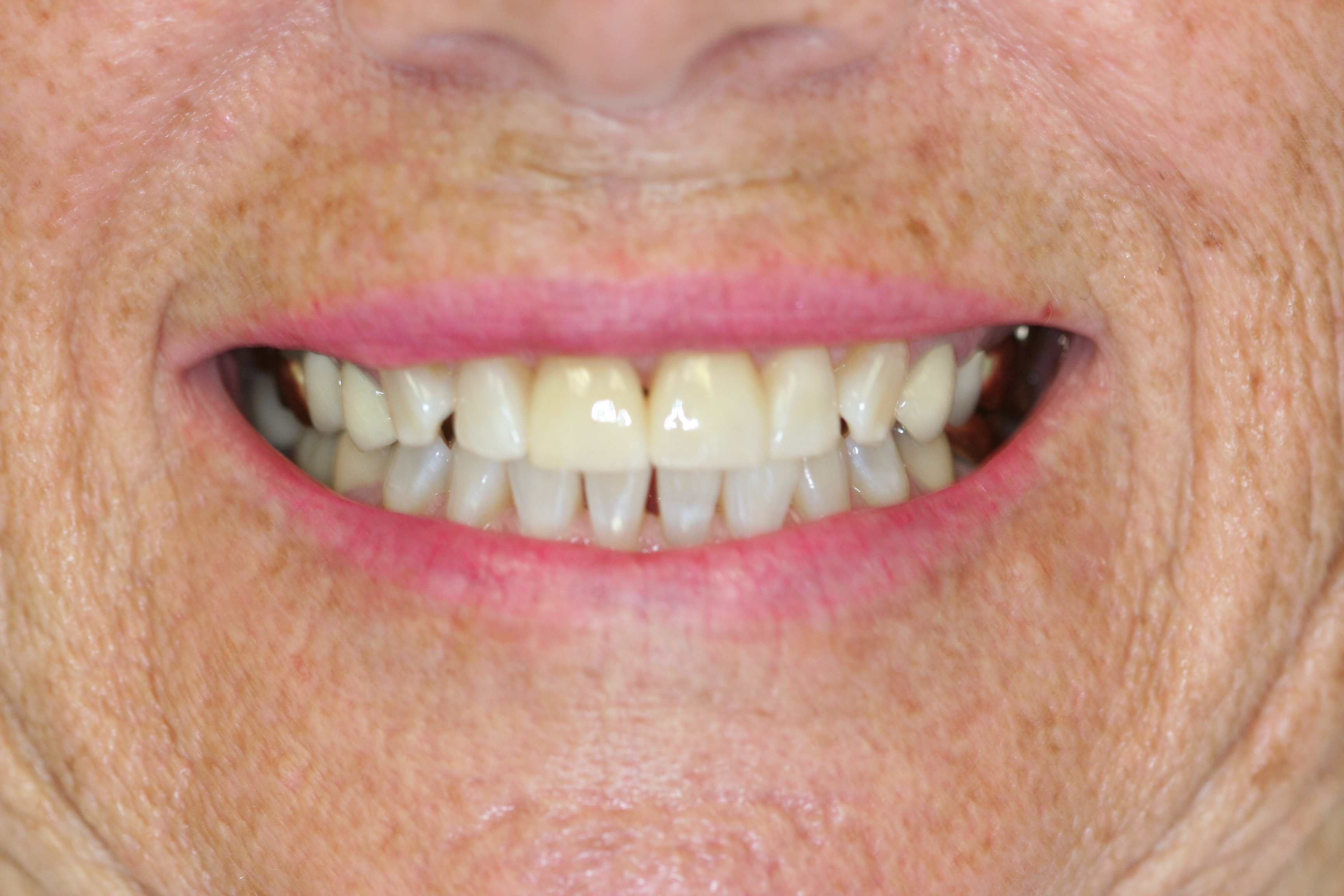 before veneers