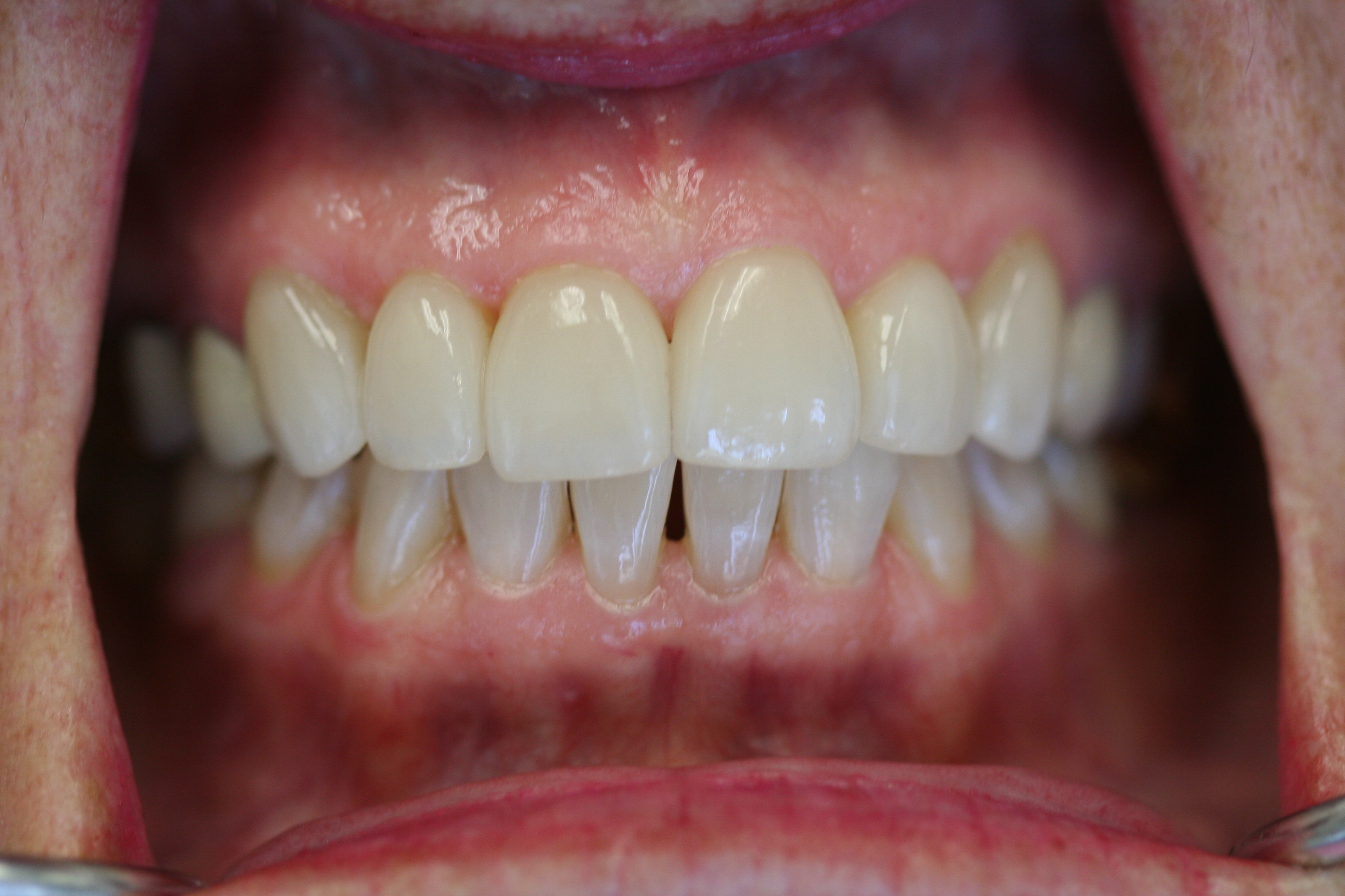 after veneers
