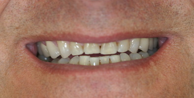 before veneers