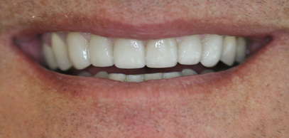 after veneers