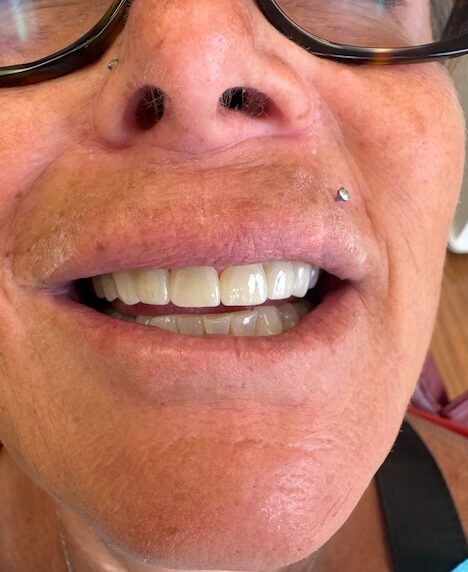patient smiling with six new anterior crowns OlsonDDS HB